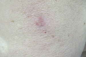 Pink tumor measuring 1cm in diameter, localized on the left arm.