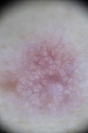 Dermoscopy image showing yellowish globules and vascular erythematous areas. Focal area with a pigment network on the left and a white patch in the lower right area of the image.