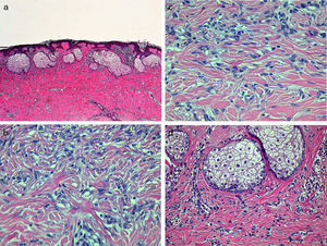 A, A poorly defined proliferation of spindle-shaped cells with nests of sebaceous cells in the more superficial region. Hematoxylin and eosin (H&E), original magnification×40. B, At higher magnification, a dermal proliferation formed of spindle-shaped cells with a whorled pattern. H&E, original magnification×200. C, Entrapment of collagen fibers between fibroblastic cells at the periphery of the lesion. H&E, original magnification×200. D, The nests of sebaceous cells at higher magnification. H&E, original magnification×100.
