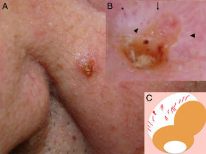 A Clinical image: erythematous papule on the left cheek. B, Dermatoscopy (with polarized light): linear vessels arranged radially in a triangle formation and hairpin vessels surrounded by reflective whitish areas, and a central crusted and hyperkeratotic area. C, Schematic representation of the dermoscopic image. Note the vascular pattern: linear vessels (arrow), hairpin vessels (arrow tip), linear vessel with distal thickening (asterisk). The keratin mass is shown in white and the crust in orange.