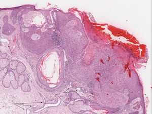 Histological image (hematoxylin and eosin, x8). A well-defined neoplastic proliferation was observed in the superficial dermis, in contact with the epidermis. It was made up of squamous cells, some with vacuolization, with foci of keratinization and corneal microcysts. Note the ulcerated epidermis and dilated vessels in the tumor periphery (arrows).