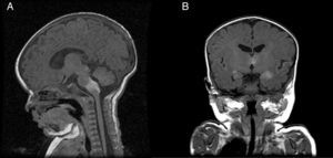 A. Sagittal magnetic resonance image of the brain: hyperintense T1 image at the junction of the medulla oblongata and the pons. B. Coronal magnetic resonance image of the brain: hyperintense T1 images at the level of the thalamus and temporal lobes.