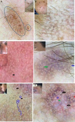 Clinical and dermoscopic images of PAK showing: A,C,E. the rhomboidal pattern (blue circle).C,E: the rosette sign (black arrow). B and D: the annular granular pattern (blue arrow), the inner gray halo around the yellowish central keratin (D: green arrow). F: the dermoscopic horn (black arrow), the gray halo around the yellowish central keratin (red arrow), the rosette sign (blue arrow), the double white clods (green arrow). G: Central crusts (black arrow), the white globule (red arrow), the rosette sign (blue arrow), the double white clods attached against each other (green circle). H: the superficial pigmentation with the jelly sign, the double white clods (green circle), the white globule (black arrow).