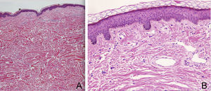 A, Hematoxylin-eosin, original magnification ×10. B, Hematoxylin-eosin, original magnification ×40.