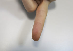 Brown macule on the third finger of the left hand.