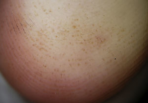 Multiple irregular reddish-brown spots (“pebbles”). The spots were mainly distributed on the ridges of the skin markings.