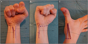 Peripheral nerve blocks at the wrist. A, Median nerve block. B, Ulnar nerve block. C, Radial nerve block. Abbreviations EPB, extensor pollicis brevis tendon; EPL, extensor pollicis longus tendon; FCR, Flexor carpi radialis tendon; FCU, flexor carpi ulnaris tendon; P, pisiform bone; PL, palmaris longus tendon.