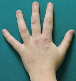 Granuloma annulare over the metacarpophalangeal joint of the left hand.