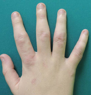 Granuloma annulare on the dorsum of the phalanges of the right hand.