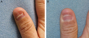 A, Subungual wart prior to treatment. B, After 7 treatment cycles.
