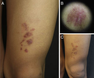 Clinical and dermoscopic images of the patient. A, Grouped, shiny erythematous-purpuric plaques with fine superficial desquamation on the left knee. B, Dermoscopy showing red dots on a brownish-gray background with a fine network. C, Clinical course of the lesion after several attempted treatments. Note persistence of the plaques but with a slight reduction in color.