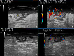 Skin ultrasound: A and B, Initial phase. The asterisks mark linear hypoechoic areas corresponding fistulous tracts. C and D, Image after a week of treatment: thinning of the hypoechoic subepidermal band, and decreased vascularity in the color Doppler image. The hypoechoic tracts persist in the subepidermal tissue.