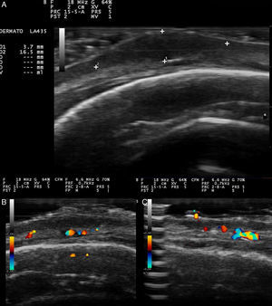 A, Hypoechoic nodule with well-defined borders that are slightly more echogenic than the center of the nodule. B, Color Doppler showed increased vascularity and asymmetrically distributed medium-sized vessels in the base of the nodule. C, Increased vascularity in the non-nodular area of the lesion.