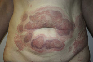 Geographic erythematous-purpuric plaques at the sites of injection of mesotherapy on the abdomen, hips, and thighs.
