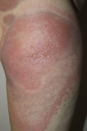 Confluent, erythematous edematous plaques with vesicles at the sites of injection of mesotherapy on the thigh.
