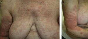 A and B, Urticarial rash of fleeting pink edematous papules and plaques on the trunk and limbs, with no desquamation.