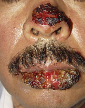 Severe oral mucositis, also involving the nose.