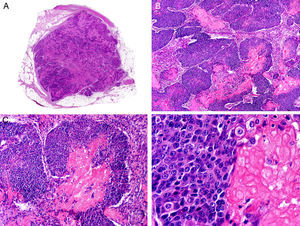 Histopathologic characteristics of pilomatrix carcinoma. A, Panoramic view showing a lesion formed by numerous tumor islands invading the dermis. B, Islands of matricial cells containing shadow cells in the center. C, Detail of matricial and shadow cells. D, High-magnification view of neoplastic cells with matricial differentiation. (Hematoxylin-eosin, original magnification ×10 [A], ×40 [B], ×200 [C], ×400 [D]).