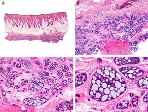 Histopathologic characteristics of adenoid cystic carcinoma. A, Panoramic view showing a poorly circumscribed tumor invading the subcutaneous facia, B, Higher-magnification view showing an adenoid cystic pattern in the neoplastic cells. C, Neoplastic aggregates of varying shapes and sizes with an adenoid cystic pattern. D, Higher-magnification view of neoplastic cells. (Hematoxylin-eosin, original magnification ×10 [A], ×40 [B], ×200 [C], ×400 [D]).