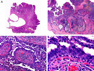 Histopathologic characteristics of syringocystadenocarcinoma papilliferum. A, Panoramic view showing neoplastic aggregates of varying shapes and sizes invading the dermis. B, Papillary structures connected to the epidermal surface. C, Note how these papillary structures are lined with a double layer of epithelial cells. D, Images of nuclear atypia and pleomorphism in the epithelial cells lining the papillae. (Hematoxylin-eosin, original magnification ×10 [A], ×40 [B], ×200 [C], ×400 [D]).