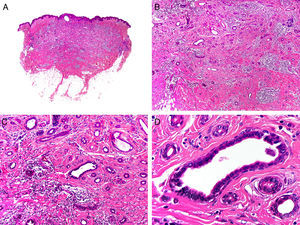 Histopathologic characteristics of tubular carcinoma. A, Panoramic view showing tubular structures invading the dermis. B, Tubular structures immersed in a sclerotic stroma. C, Tubular structures of varying shapes and sizes. D, Signs of decapitation secretion in one of the tubules. (Hematoxylin-eosin, original magnification ×10 [A], ×40 [B], ×200 [C], ×400 [D]).