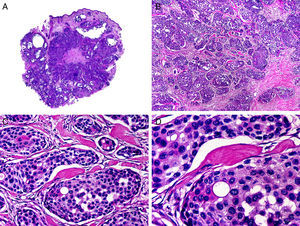 Histopathologic characteristics of papillary apocrine hidradenocarcinoma. A, Panoramic view of a tumor invading the full thickness of the dermis. B, Neoplastic aggregates of varying shapes and sizes. C, Note the cells with a pale cytoplasm in some of the neoplastic aggregates. D, Detail of a neoplastic aggregate with ductal differentiation. (Hematoxylin-eosin, original magnification ×10 [A], ×40 [B], ×200 [C], ×400 [D]).