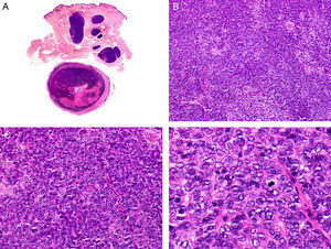 Histopathologic characteristics of spiradenocarcinoma. A, Panoramic view showing a spiradenoma in the dermis and a spiradenocarcinoma nodule in the subcutaneous tissue. B, The nodule is formed by a sheet of neoplastic cells. C, Note the pleomorphic nuclei and frequent mitotic figures in the neoplastic cells. D. High-magnification view of neoplastic cells, several of which are in mitosis. (Hematoxylin-eosin, original magnification ×10 [A], ×40 [B], ×200 [C], ×400 [D]).