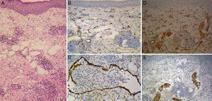 Skin biopsy. A, Panoramic view (hematoxylin-eosin, original magnification ×100) showing dilated vessels in the reticular dermis, some with empty lumens and others with mononuclear cell aggregates. B, Positive staining for CD34 (original magnification ×100). C, Positive staining for D2-40 (original magnification ×400). D, Positive staining for CD31 (original magnification ×100). E, Intraluminal cells positive for CD68.