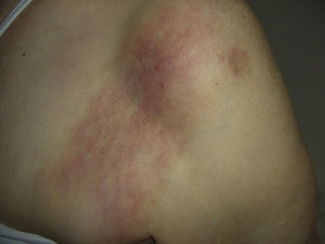 Case 2. Erythematous, edematous plaque with imprecise borders on the anterior surface of the left shoulder, extending to the pectoral area.