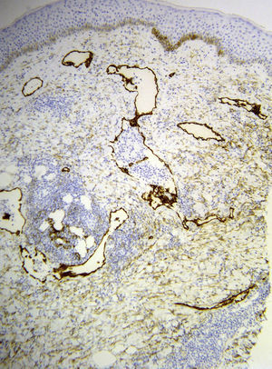 Skin biopsy. Cells positive for D2-40 (specific marker for lymphatic vessels) in the vessel walls (original magnification ×100).