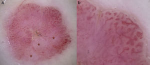 A, Dermoscopic image showing structureless pale pink areas (asterisks) within the lesion and prominent peripheral vascularity. B, Detail of the blood vessels with the characteristic cherry blossom images.