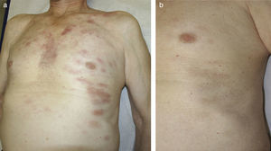 A, Initial presentation: desquamating erythematous plaques on the chest and flanks. B, Healing of the skin lesions a month after completing chemotherapy treatment.