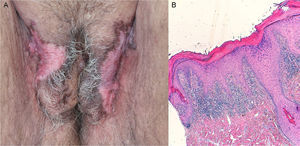 A, Pubic region and labia majora showing whitish, atrophic plaques with scarring alopecia and hyperpigmented borders. B, Hyperkeratosis, a lichenoid infiltrate in the superficial dermis and perifollicular regions, vacuolar degeneration of the basal layer, and apoptotic keratinocytes. Hematoxylin and eosin, original magnification×100.