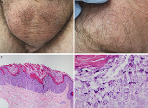 A, Diffuse scrotal erythema and small, isolated papules. B, Detail of the lesions: multiple hyperkeratotic scrotal papules. C, Epidermolytic acanthoma: irregular acanthosis with orthokeratotic hyperkeratosis and papillomatosis. Hematoxylin and eosin (H&E), original magnification×40. D, Detail of the increased number of keratohyalin granules in the stratum granulosum and focal acantholysis. H&E, original magnification×400.