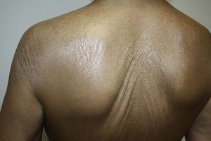 Thin, wrinkled, atrophic skin with a cigarette-paper appearance on the patient's back.