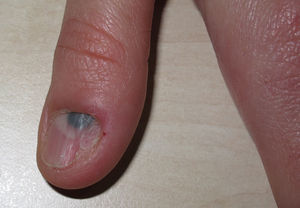 Semicircular bluish-black macule and nail dystrophy.