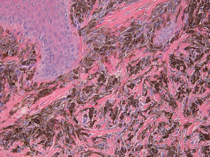 Intensely pigmented bipolar melanocytes in the dermis, between thick collagen fibers. Hematoxylin and eosin, original magnificationx200.