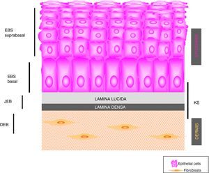 Graphic representation of a histological section of skin showing the different layers of skin and the cell types in these layers. The cleavage level of each type of EB is shown.