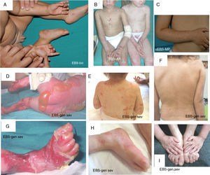 Clinical manifestations of basal EBS. The keratin-encoding genes (KRT5, KRT14) are causative of the disease in all patients.19,20 Photographs obtained with signed informed consent (Source: u714-CIBERER-CIEMAT-UC3M-IISFJD). A, Palmoplantar involvement of a patient with localized EBS during infancy. B, Generalized involvement of 2 siblings with EBS, of consanguineous parents, with autosomal recessive transmission19. C, Mottled pigmentation in a patient with EBS-MP.21 D-G, Extensive involvement in a neonate with generalized severe EBS. E-F-H-I, Progression during infancy. E, Widely distributed herpetiform lesions on the patient
