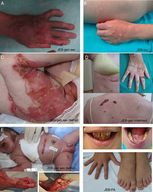 Clinical manifestations of JEB. Photographs obtained with signed informed consent (Source: U714-CIBERER-CIEMAT-UC3M-IISFJD). A-B, Severe generalized JEB caused by mutations in the LAMC2 gene with absence of Lam 332, specifically the γ2 chain, which led to neonatal death in one of the patients. C, Intermediate generalized JEB. D, Localized JEB. In both patients, mutations were found in the COL17A1 gene, leading to reduced expression and complete absence of Col17, respectively. Note the postinflammatory hypopigmentation. E-F, JEB with pyloric atresia caused by mutations in the ITGB4 gene; protein expression was comparable to that of control in patient F and absent in the lethal form (not shown).22 Both patients underwent corrective surgery for pyloric atresia.