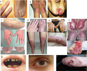 Clinical Manifestations of DEB. Clinical photographs of Spanish patients obtained with signed informed consent (Source: U714-CIBERER-CIEMAT-UC3M-IISFJD). Mutations in the gene that encodes collagen type VII (COL7A1) is the cause of the disease in all patients.23,24 A, Dominant DEB, nails only. B, Dominant DEB, generalized. C, Recessive DEB, localized. D, Recessive DEB, pretibial. E, Recessive DEB, generalized (non Hallopeau-Siemens syndrome). F, Recessive DEB, generalized severe (Hallopeau-Siemens). F, Recessive DEB, generalized severe (Hallopeau-Siemens). G-I, Other complications in patients with severe generalized RDEB. G, Microstomia with dental abnormalities and caries. H, Scarring and ocular blisters (lower eyelid). I, Squamous cell carcinoma on the stump of the left hand.