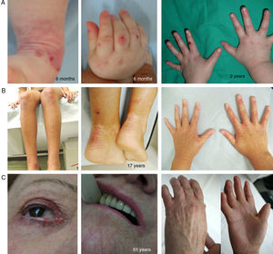 Clinical Manifestations of KS. Clinical photographs of patients obtained with signed informed consent (Source: U714-CIBERER-CIEMAT-UC3M-IISFJD). Mutations in the gene that encodes kindlin 1 (KIND1) is the cause of the disease in all patients.26–28 A, Erosions and premature aging of the skin, incipient already in infancy, on the backs of the hands. B, Evident cutaneous aging and poikiloderma along with nail dystrophy in a young patient. C, Ocular involvement, poikiloderma, interdigital synechia, and contracture of the hands in a female patient in her sixties.