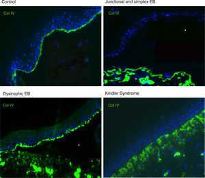 Col IV Immunofluorescence. Col IV can be observed at the floor of the blister in both JEB and EBS. In DEB, Col IV is observed in the roof of the blister, whereas in KS, a reduplication of the basement membrane is observed, distinctive for this disease. Source: Dr. Marta García (U714-CIBERER-CIEMAT-UC3M-IISFJD).