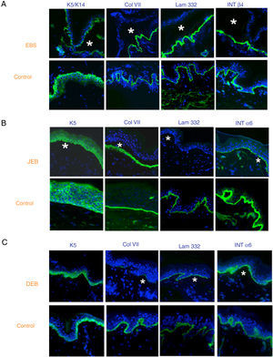 Classification of EB and selection of candidate gene by antigen mapping (first screening) in histological sections of biopsies of cryopreserved skin. Microphotographs: Dr. Marta García (U714-CIBERER-CIEMAT-UC3M-IISFJD). A, Immunophenotype of basal EBS. The K5 and K14 keratins mark the floor and roof of the blister as a result of intraepidermal cleavage. Labeling of the remaining proteins is localized in the floor of the blister. The result indicates that the candidate genes in the initial screening are KRT5 and KRT14. B, Immunophenotype of JEB. As a result of cleavage of the intralamina lucida, labeling of the keratins is restricted to the blister roof while that of collagen VII remains in the lister floor. In this case, the absence of labeling of laminin 332 indicates that the candidate genes are LAMA3, LAMB3, and LAMC3, and that the molecular subclassification is JEB (see Table 5). Note that the absence of Lam332 can affect expression of integrins. C, Immunophenotype of DEB. As a result of cleavage at the level of the papillary dermis, all markers map to the roof of the blister. This result indicates that the candidate gene is COL7A1. The almost complete absence of Col VII is consistent with generalized severe DEB (see Table 5).