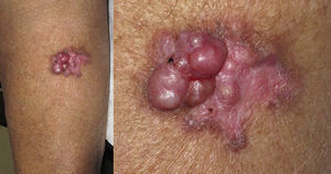 Reddish, infiltrated plaque measuring 6 × 3.5cm on the front of the left thigh. Fairly solid, ulcerated nodular formations overlie the lesion. Small hemorrhagic points can be seen.