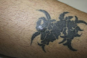Papulonodular pattern limited to an area of the tattoo. Histology compatible with cutaneous sarcoidosis.