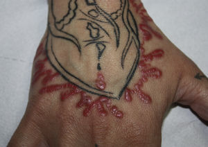 Papular-lichenoid pattern in a patients with a probable allergic reaction to red tattoo ink. The color in this figure can only be fully appreciated in the electronic version of the article.