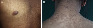 Clinical appearance of the lesions: brown confluent and reticulated plaques on the chest (A) and nape of the neck (B).