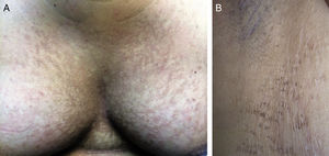 A and B. Reticulated plaques forming linear pseudo-striae mixed with areas of healthy skin.