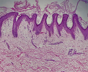Histopathology findings in the skin biopsy: epidermis with mild hyperkeratosis. Acanthosis and papillomatosis of the rete ridges. Perivascular inflammatory infiltration of the dermis (hematoxylin-eosin, original magnification ×10).